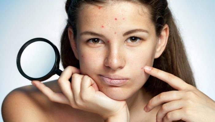 Shining a light on acne therapies