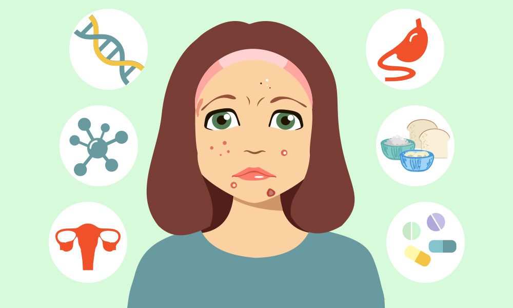 What Causes Acne - Acne Causes - All About Acne