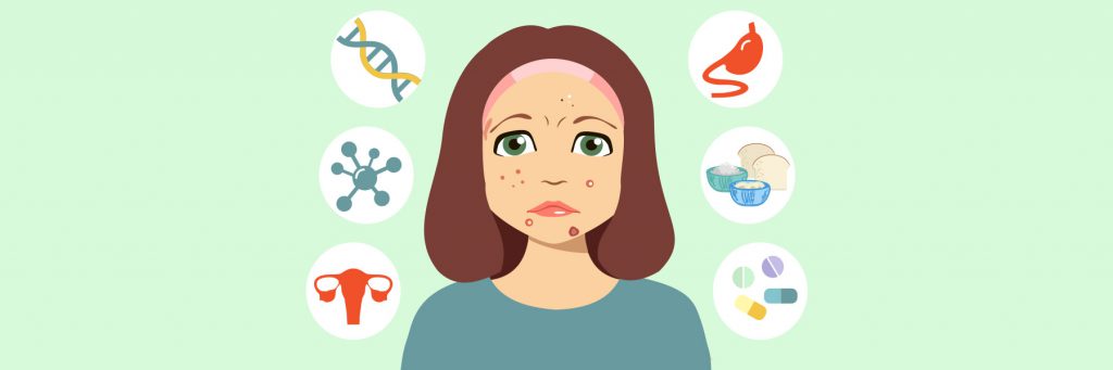 There are many causes of acne and different treatments target each of these causes.