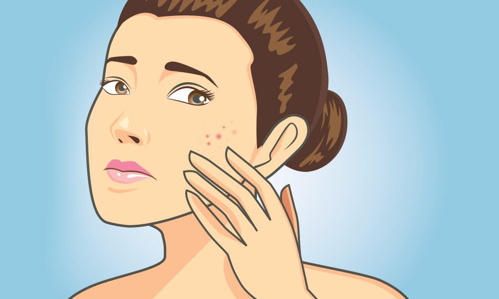 Mild Acne Whiteheads and Blackheads All About Acne