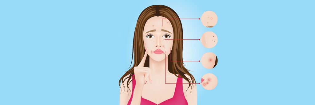 Types of Acne