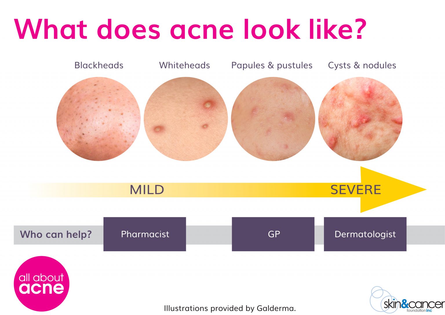 Types Of Acne - Types of Pimples - All About Acne