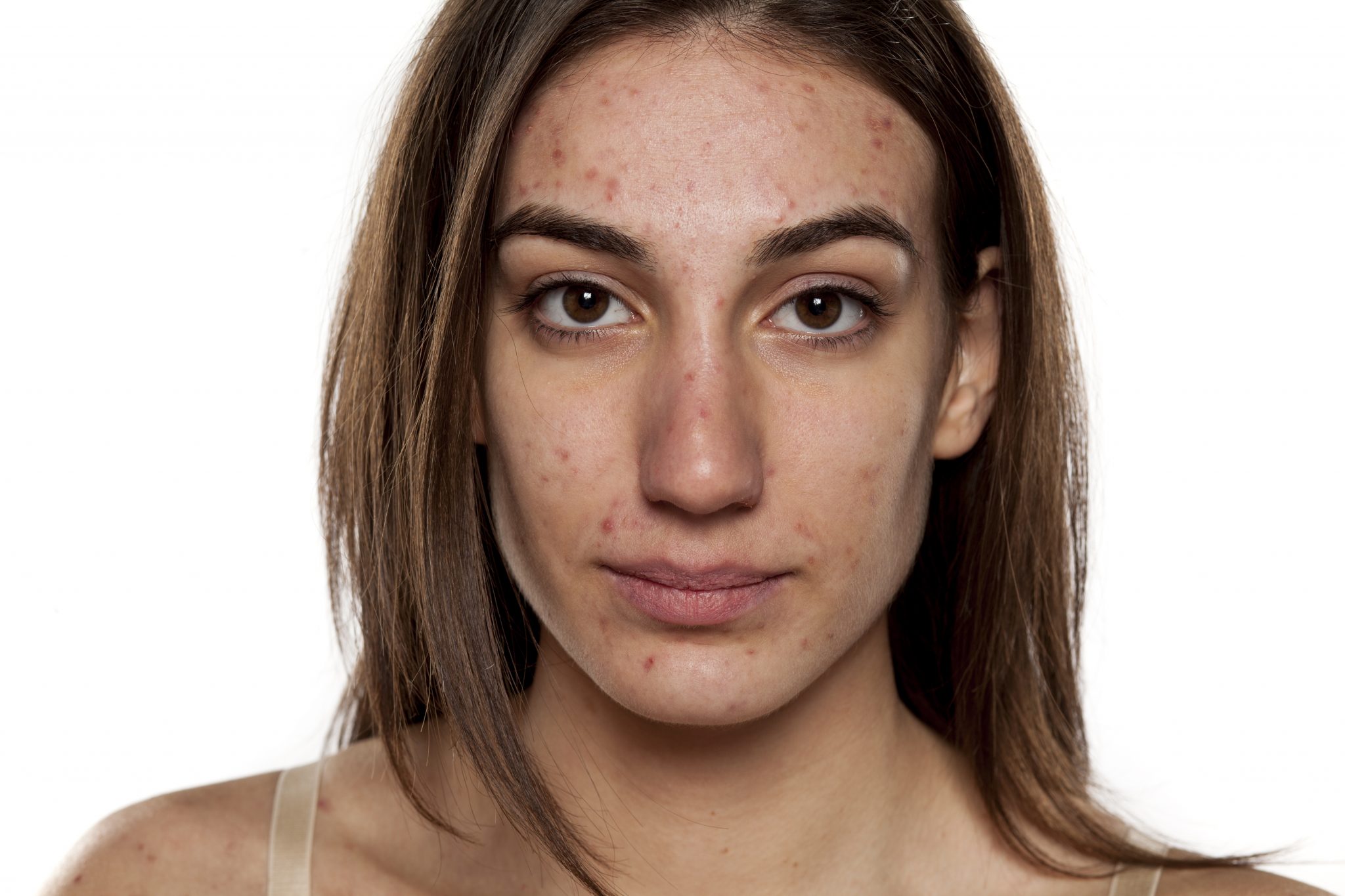 people-with-acne-avoid-seeking-treatment-because-of-misconceptions