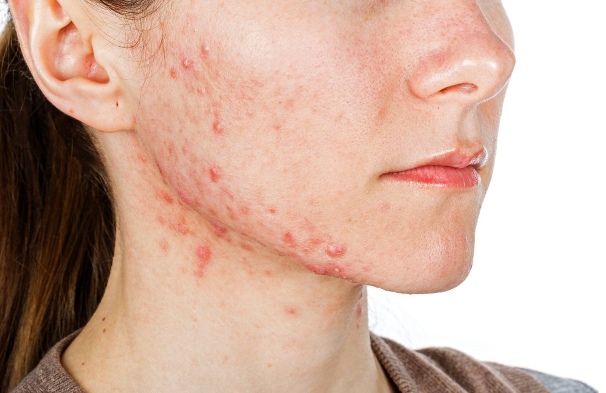 people with acne have more diverse skin microflora