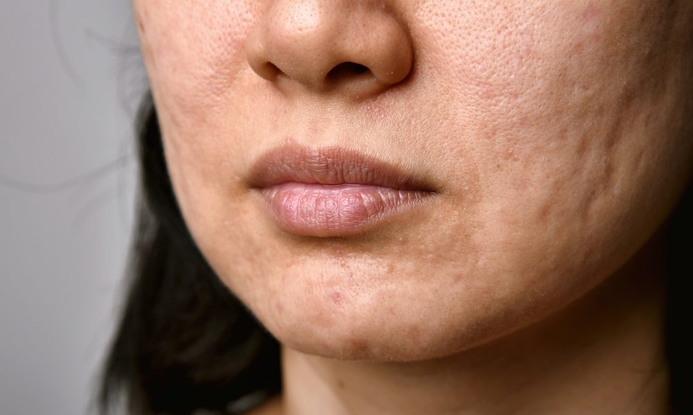 How the menstrual cycle affects hormonal acne for varying ethnicities