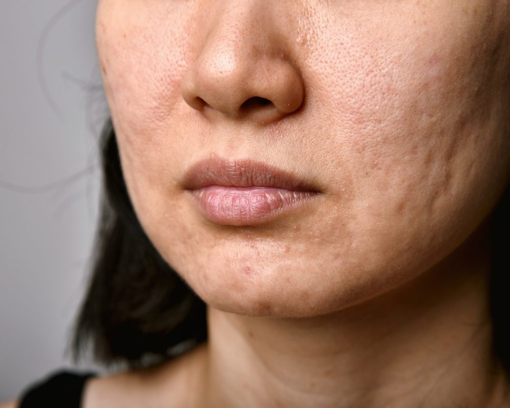How the menstrual cycle affects hormonal acne for varying ethnicities