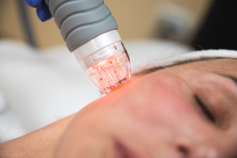 Fractional RF Microneedling: a Dual Solution for Acne and Scarring