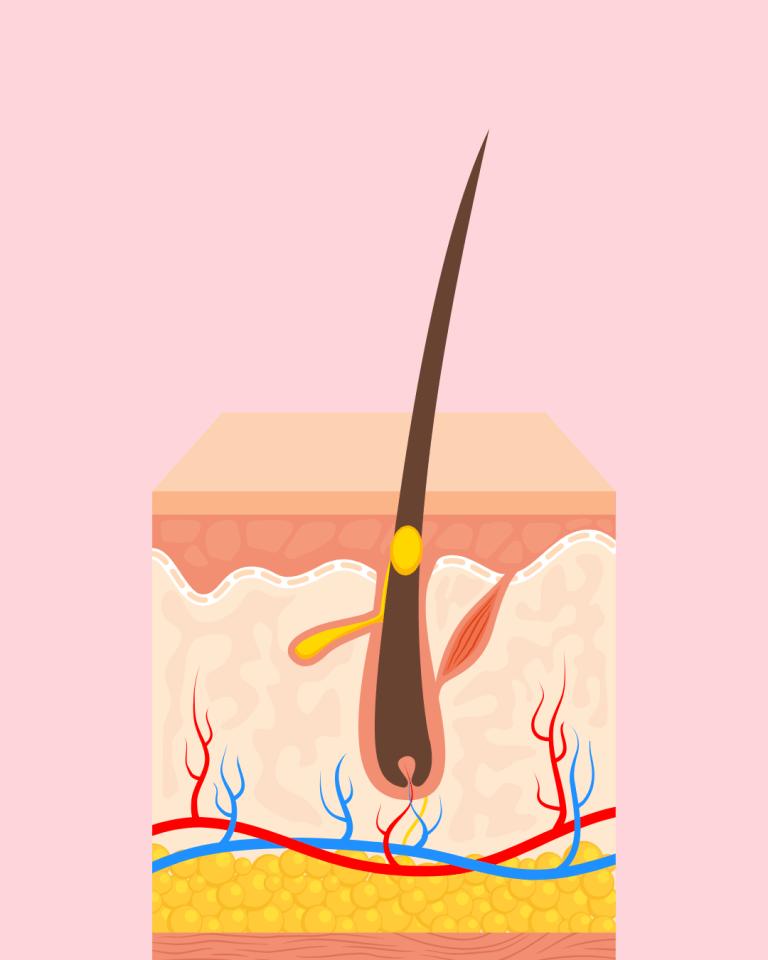 Why the Microcomedone Is More Than Just a Plug 